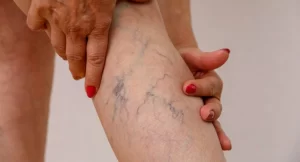 o que são vasos nas pernas